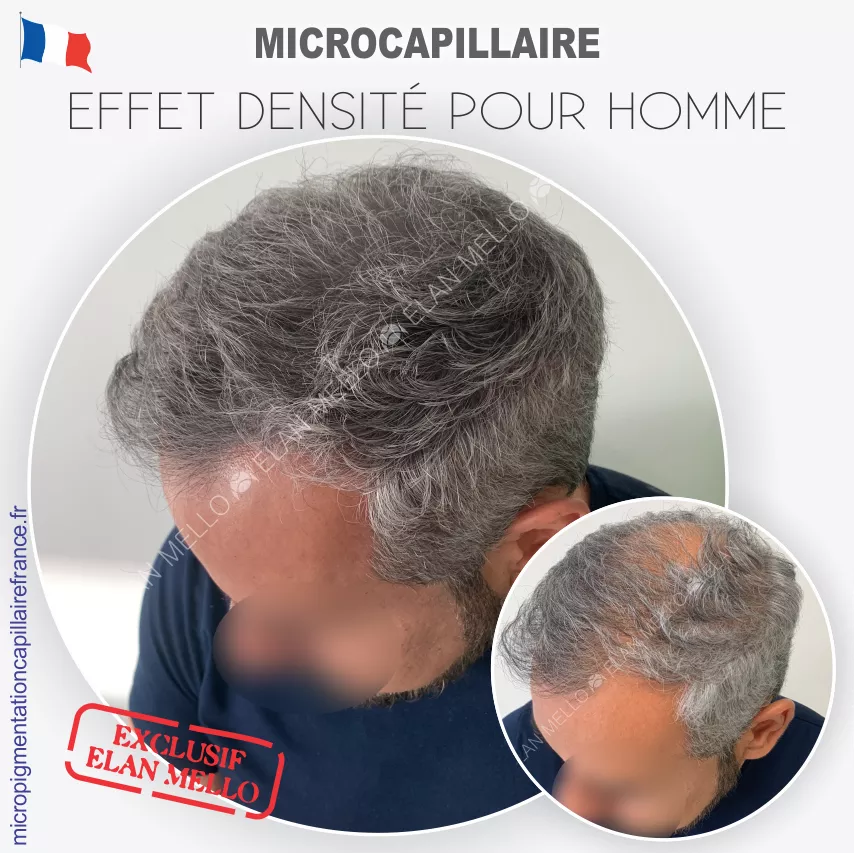 Microcapillaire Effet Densité - Micropigmentation Cheveux