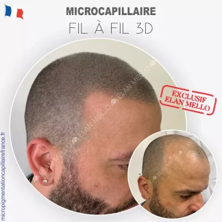 Microcapillaire Fil à Fil 3D - Micropigmentation Cheveux