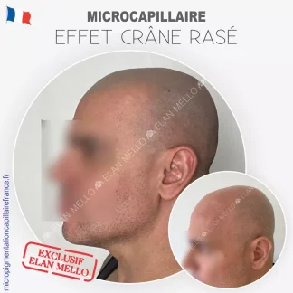 Microcapillaire Effet Crâne Rasé - Micropigmentation Cheveux