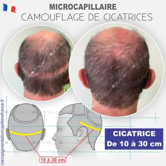 Microcapillaire en Cicatrice du Cuir Chevelu - de 10 à 30 cm - Micropigmentation Capillaire